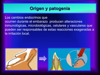Origen y patogenia
Los cambios endocrinos que
ocurren durante el embarazo producen alteraciones
inmunológicas, microbiológicas, celulares y vasculares que
pueden ser responsables de estas reacciones exageradas a
la irritación local.
 