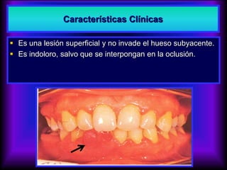  Es una lesión superficial y no invade el hueso subyacente.
 Es indoloro, salvo que se interpongan en la oclusión.
Características Clínicas
 