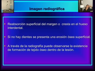  Reabsorción superficial del margen o cresta en el hueso
interdental.
 Si no hay dientes se presenta una erosión ósea superficial.
 A través de la radiografía puede observarse la existencia
de formación de tejido óseo dentro de la lesión.
Imagen radiográfica
 
