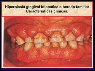 Hiperplasia gingival idiopática o heredo familiar
Características clínicas.
 