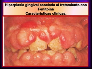 Hiperplasia gingival asociada al tratamiento con
Fenitoína
Características clínicas.
 