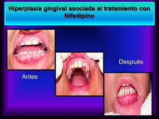 Hiperplasia gingival asociada al tratamiento con
Nifedipino
Antes
Después
 