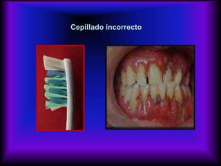 Cepillado incorrecto
 