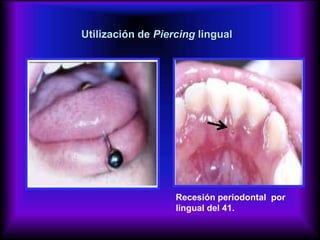 Utilización de Piercing lingual
Recesión periodontal por
lingual del 41.
 