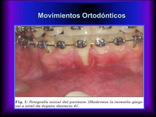 Movimientos Ortodónticos
 