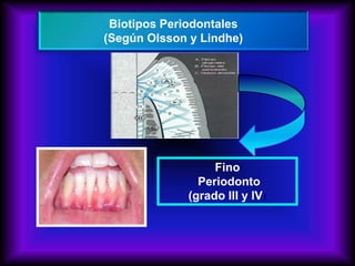 Fino
Periodonto
(grado III y IV)
Biotipos Periodontales
(Según Olsson y Lindhe)
 