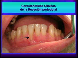Características Clínicas
de la Recesión periodotal
 