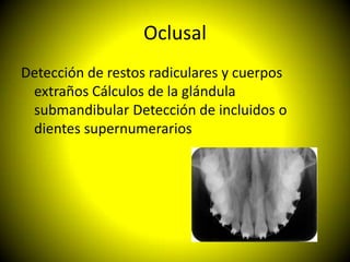 Oclusal
Detección de restos radiculares y cuerpos
 extraños Cálculos de la glándula
 submandibular Detección de incluidos o
 dientes supernumerarios
 