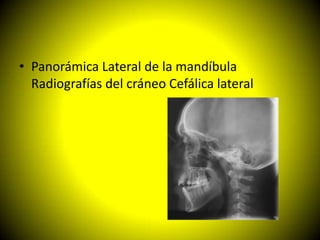 • Panorámica Lateral de la mandíbula
  Radiografías del cráneo Cefálica lateral
 