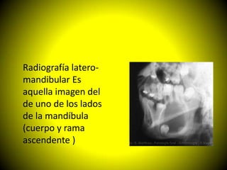 Radiografía latero-
mandibular Es
aquella imagen del
de uno de los lados
de la mandíbula
(cuerpo y rama
ascendente )
 