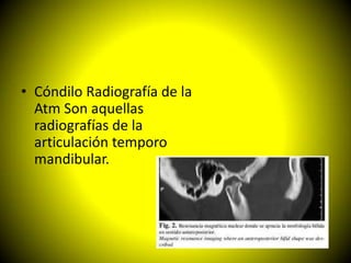 • Cóndilo Radiografía de la
  Atm Son aquellas
  radiografías de la
  articulación temporo
  mandibular.
 
