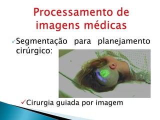  Segmentação   para planejamento
 cirúrgico:




  Cirurgia guiada por imagem
 