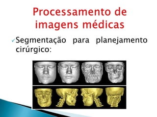  Segmentação   para planejamento
 cirúrgico:
 