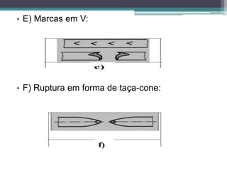 • E) Marcas em V:
• F) Ruptura em forma de taça-cone:
 