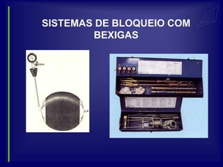 SISTEMAS DE BLOQUEIO COM
        BEXIGAS
 