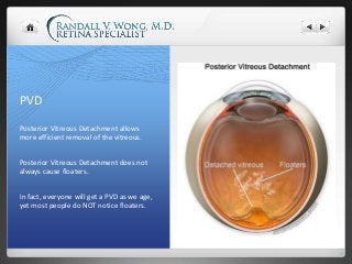 PVD
Posterior Vitreous Detachment allows
more efficient removal of the vitreous.
Posterior Vitreous Detachment does not
al...