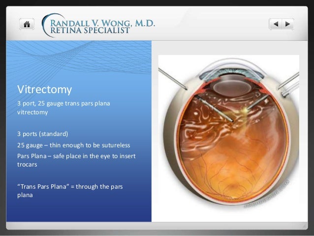 Treatment for Floaters What is Vitrectomy or FOV?