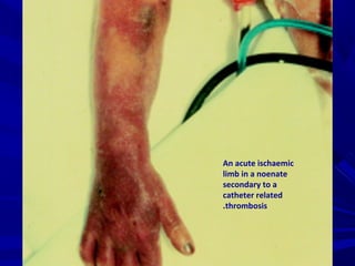An acute ischaemic
limb in a noenate
secondary to a
catheter related
thrombosis.
 