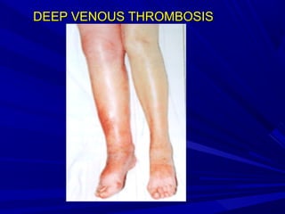 DEEP VENOUS THROMBOSISDEEP VENOUS THROMBOSIS
 