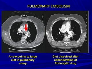 PULMONARY EMBOLISMPULMONARY EMBOLISM
Arrow points to large
clot in pulmonary
artery
Clot dissolved after
administration of
fibrinolytic drug
 