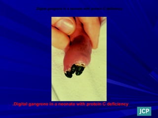 Digital gangrene in a neonate with protein C deficiency.
Digital gangrene in a neonate with protein C deficiency.
 