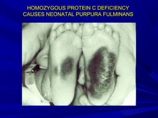 HOMOZYGOUS PROTEIN C DEFICIENCYHOMOZYGOUS PROTEIN C DEFICIENCY
CAUSES NEONATAL PURPURA FULMINANSCAUSES NEONATAL PURPURA FULMINANS
 