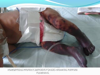 HOMOZYGOUS PROTEIN C DEFICIENCY CAUSES NEONATAL PURPURAHOMOZYGOUS PROTEIN C DEFICIENCY CAUSES NEONATAL PURPURA
FULMINANSFULMINANS
 