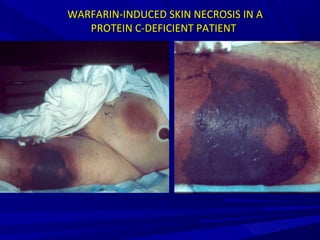 WARFARIN-INDUCED SKIN NECROSIS IN AWARFARIN-INDUCED SKIN NECROSIS IN A
PROTEIN C-DEFICIENT PATIENTPROTEIN C-DEFICIENT PATIENT
 