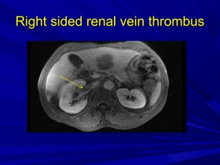 Right sided renal vein thrombusRight sided renal vein thrombus
 