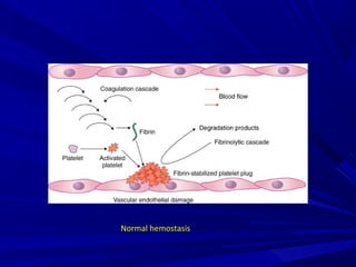 Normal hemostasis
 