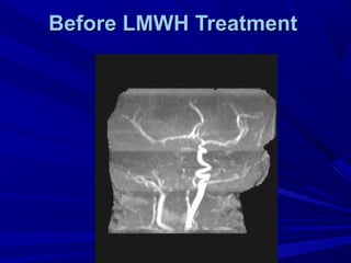 Before LMWH TreatmentBefore LMWH Treatment
 