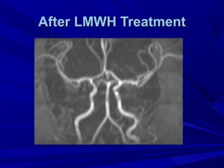 After LMWH TreatmentAfter LMWH Treatment
 