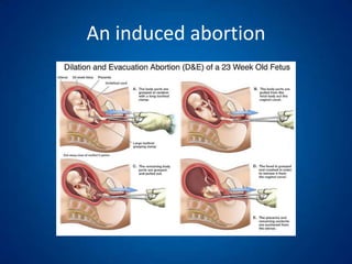 A miscarriage happens naturally.An induced abortion. usually called termination of pregnancy.