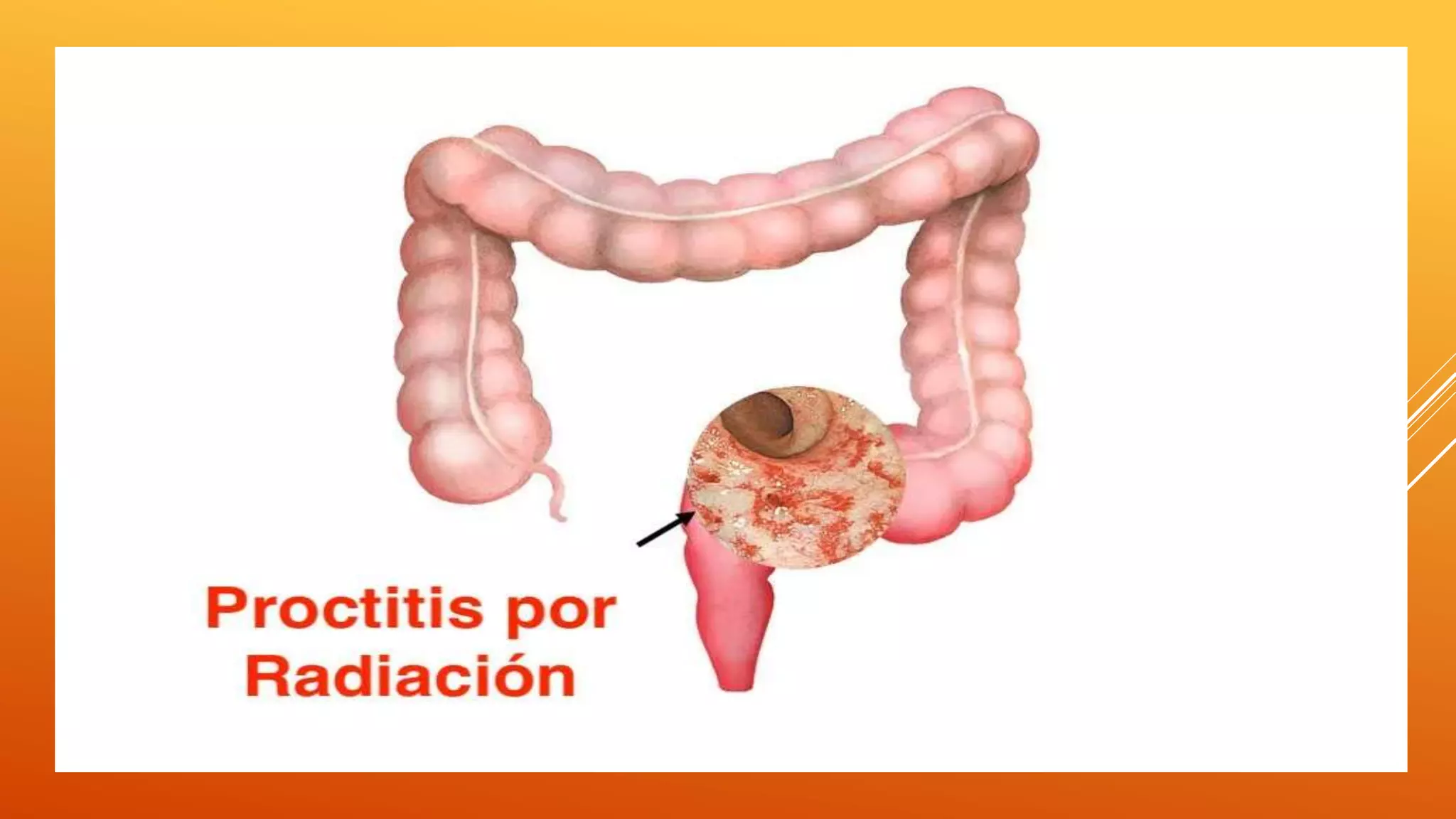 Proctitis Proctitis.pptx