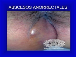 ABSCESOS ANORRECTALES
 
