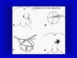 DEBRIDACÓN DE ABSCESO
 