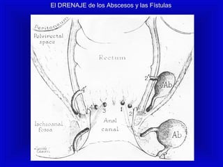 El DRENAJE de los Abscesos y las Fístulas
 