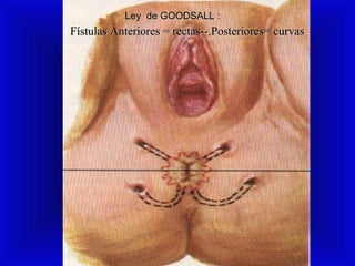 Fístulas Anteriores = rectas--.Posteriores= curvasFístulas Anteriores = rectas--.Posteriores= curvas
Ley de GOODSALL :Ley de GOODSALL :Ley de GOODSALL :
 