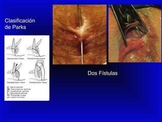 Clasificación
de Parks
Dos Fístulas
 