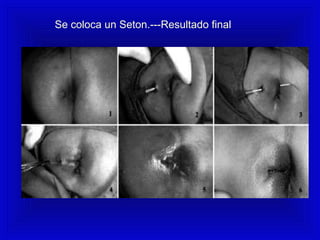 Se coloca un Seton.---Resultado final
 