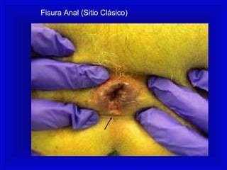 Fisura Anal (Sitio Clásico)
 