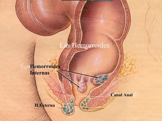 Canal Anal
Hemorroides
Internas
Las Hemorroides
H.Externa
 