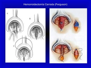 Hemorroidectomía Cerrada (Ferguson)
 