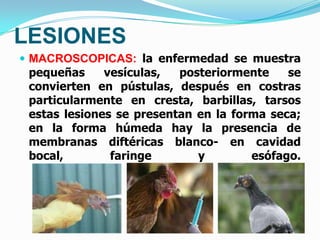 LESIONES
 MACROSCOPICAS: la enfermedad se muestra
 pequeñas     vesículas,  posteriormente    se
 convierten en pústulas, después en costras
 particularmente en cresta, barbillas, tarsos
 estas lesiones se presentan en la forma seca;
 en la forma húmeda hay la presencia de
 membranas diftéricas blanco- en cavidad
 bocal,        faringe       y        esófago.
 