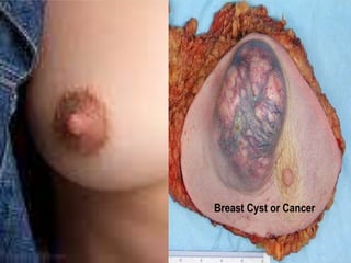 Breast Cyst or Cancer 
 