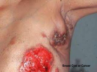 Breast Cyst or Cancer 
 