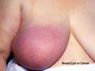 Breast Cyst or Cancer 
 