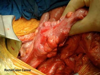 Rectal/Colon Cancer 
 
