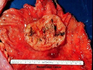 Rectal/Colon Cancer 
 
