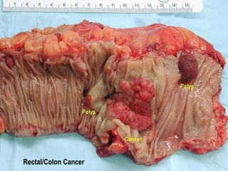 Rectal/Colon Cancer 
 